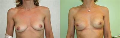 Immediate direct-to-implant breast reconstruction: A single center comparison between different procedures